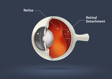 Retinal Detachment Palm Beach Gardens & Boca Raton, FL - Retinal Eye Care